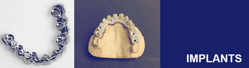Implants | Laboratoire dentaire Gati